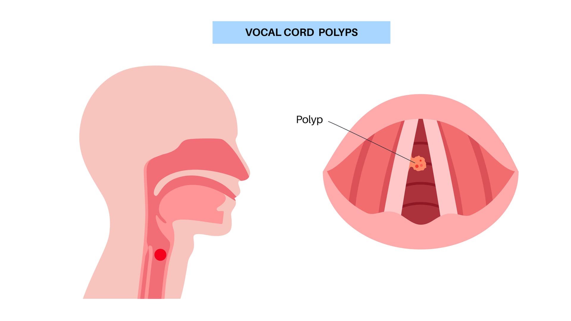 Vocal Fold Polyps: Diagnosis, Treatment, and Prevention
