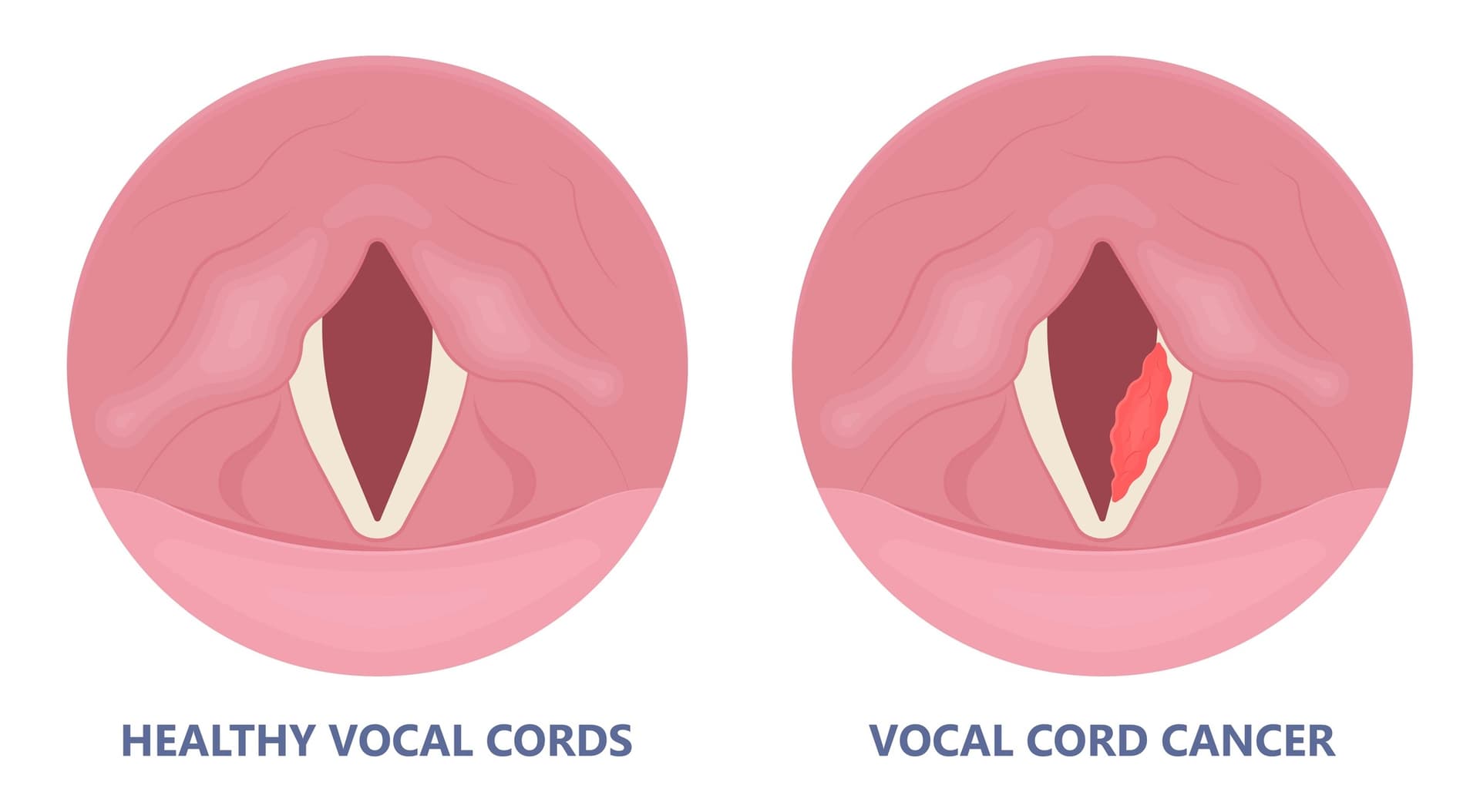 Vocal Fold Cysts: Types, Symptoms, and Surgical Intervention